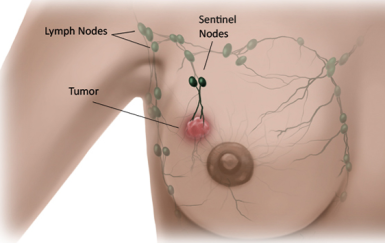 sentinel node biopsy.png